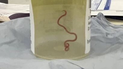 Live 3-inch worm extracted from 64-year-old woman's brain: video